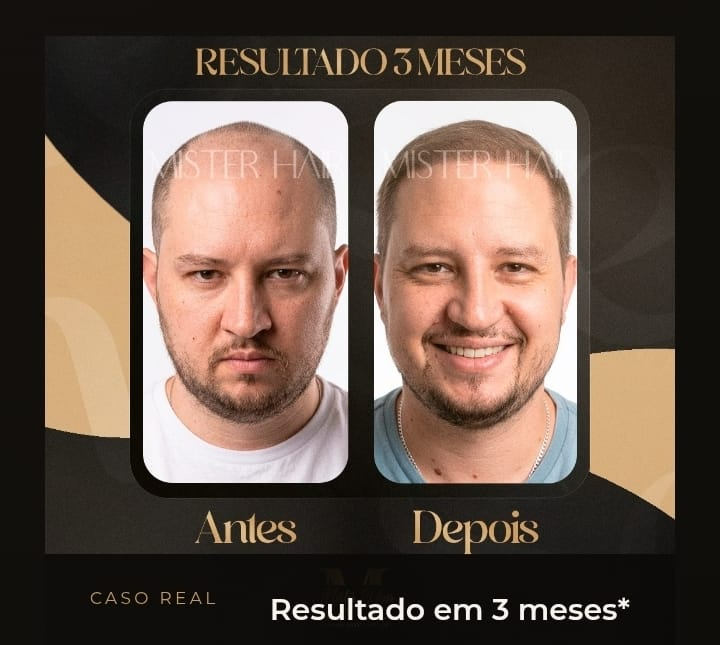 Antes e depois de transplante capilar, resultado após 3 meses