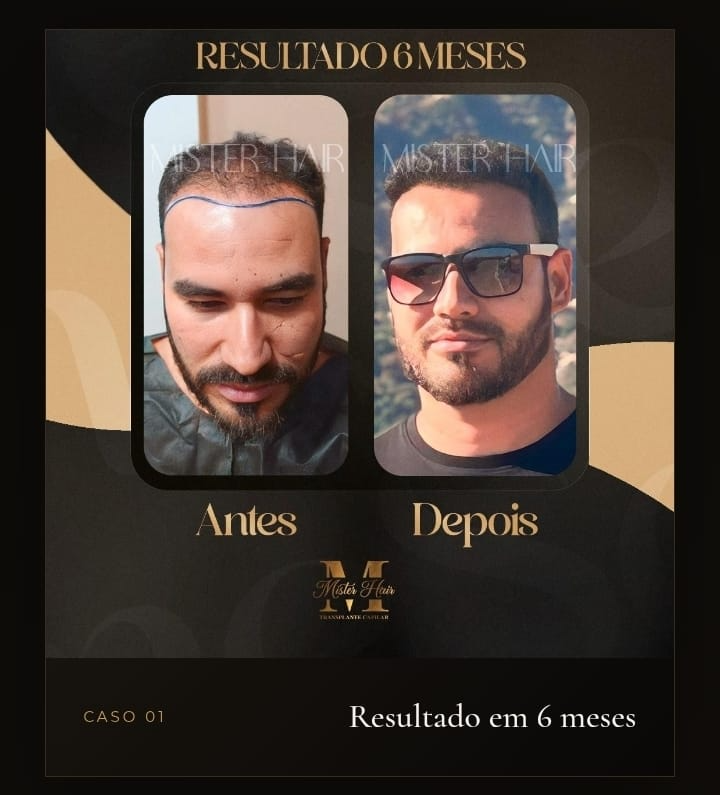 Antes e depois de transplante capilar, resultado após 6 meses